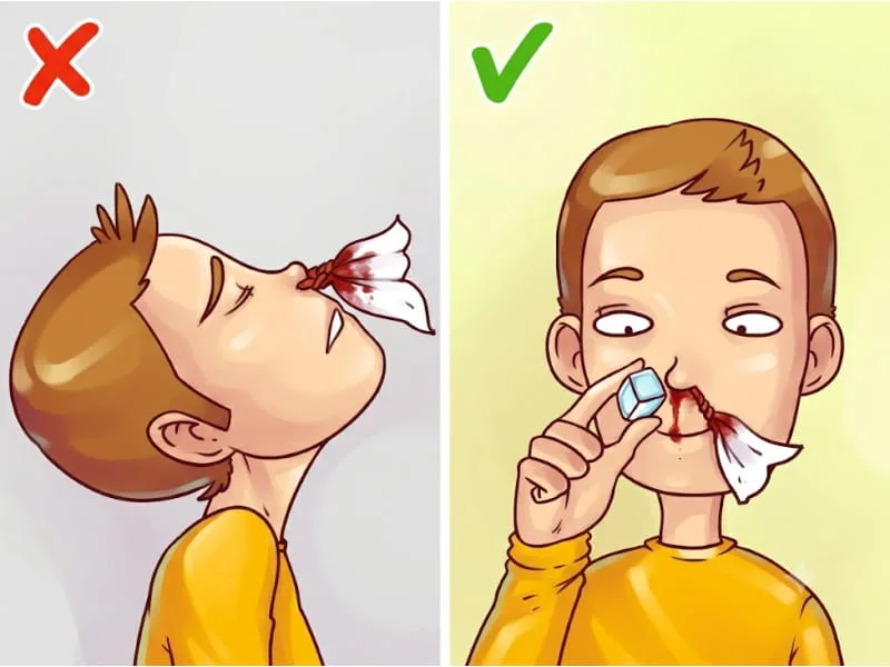 Chảy máu cam có nguy hiểm không?